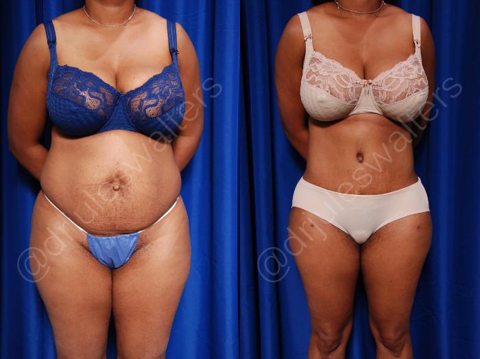 Before & After Body Contouring Case 55 View #1 View in Metairie and New Orleans, LA