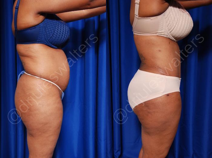 Before & After Tummy Tuck Case 55 View #2 View in Metairie and New Orleans, LA