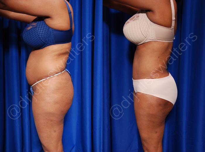Before & After Body Contouring Case 55 View #3 View in Metairie and New Orleans, LA