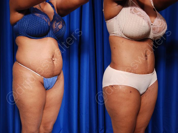 Before & After Tummy Tuck Case 55 View #4 View in Metairie and New Orleans, LA
