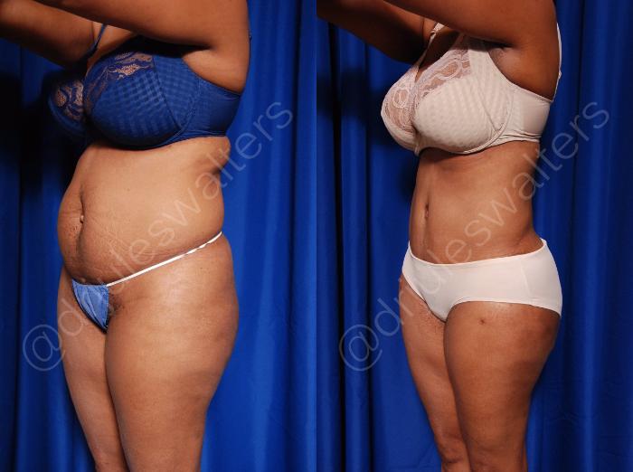 Before & After Body Contouring Case 55 View #5 View in Metairie and New Orleans, LA
