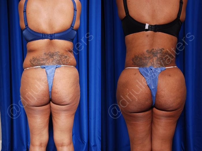 Before & After Body Contouring Case 55 View #6 View in Metairie and New Orleans, LA