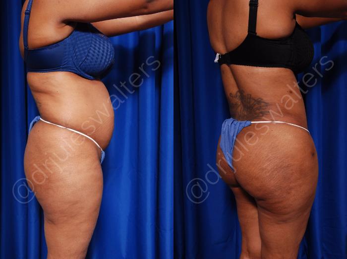 Before & After Tummy Tuck Case 55 View #7 View in Metairie and New Orleans, LA