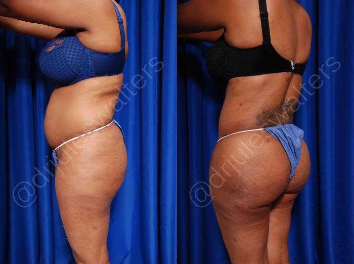 Before & After Body Contouring Case 55 View #8 View in Metairie and New Orleans, LA