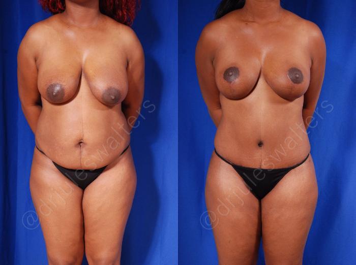 Before & After Tummy Tuck Case 56 View #1 View in Metairie and New Orleans, LA