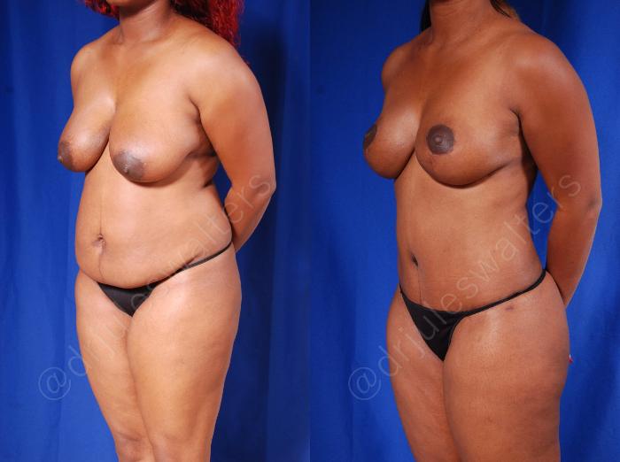Before & After Tummy Tuck Case 56 View #2 View in Metairie and New Orleans, LA