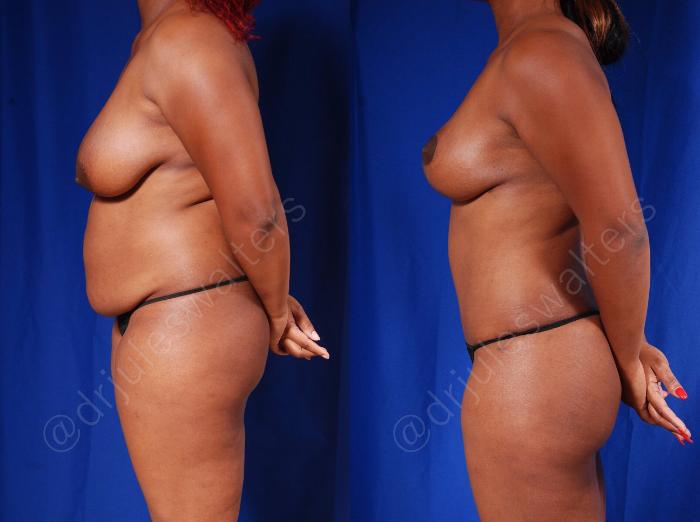 Before & After Tummy Tuck Case 56 View #3 View in Metairie and New Orleans, LA
