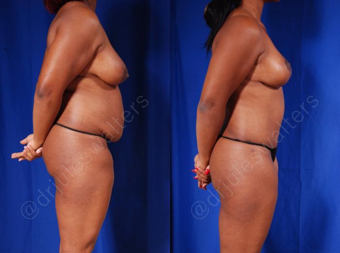 Before & After Tummy Tuck Case 56 View #5 View in Metairie and New Orleans, LA