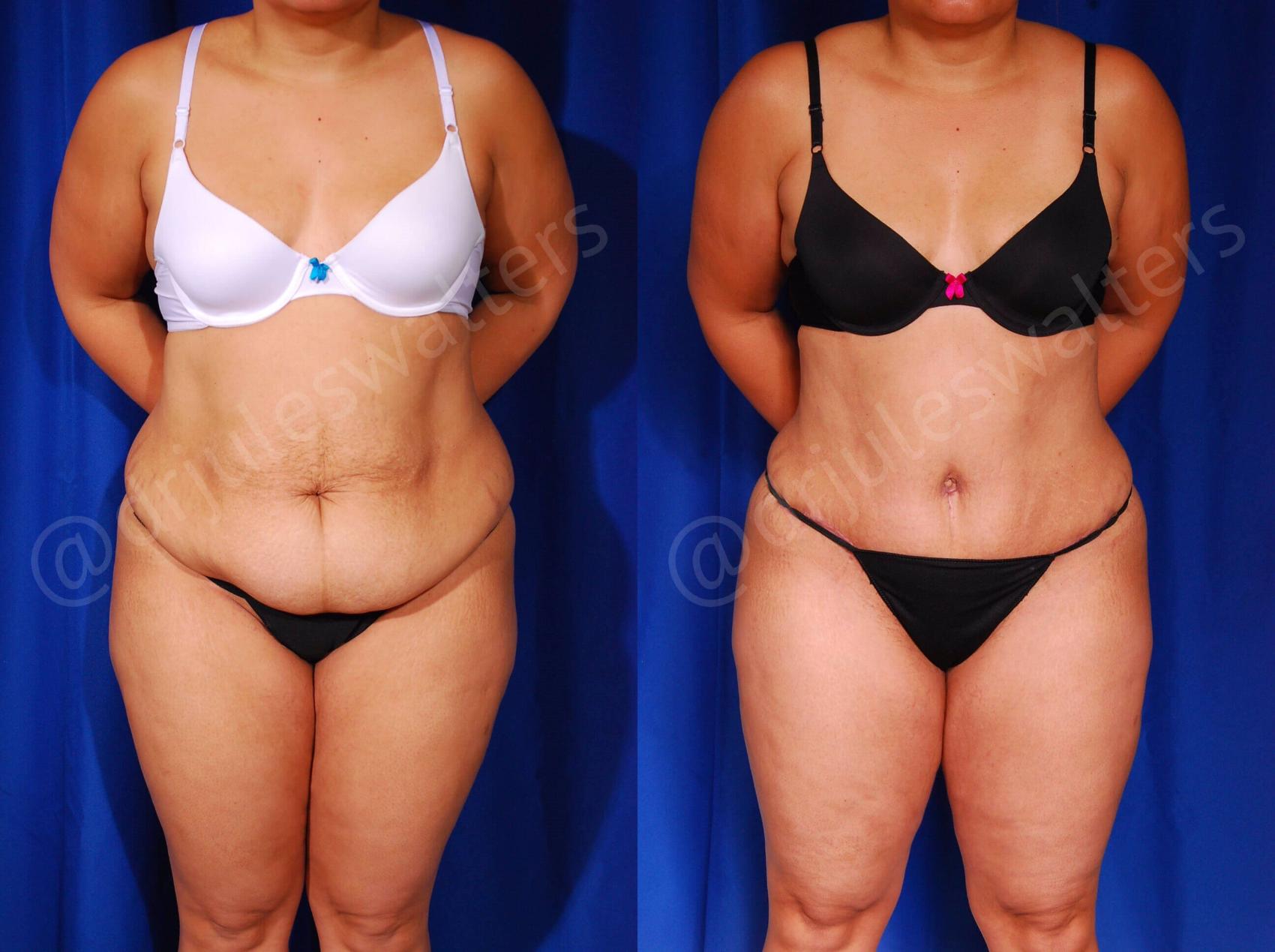 Before & After Tummy Tuck Case 57 View #1 View in Metairie, New Orleans, Covington, LA
