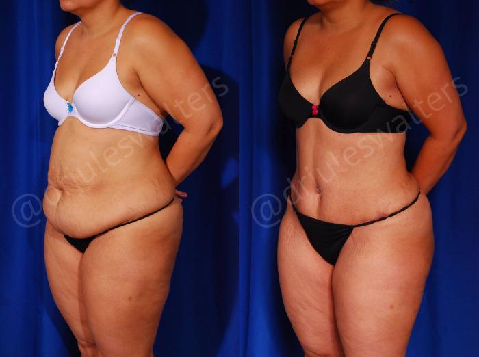 Before & After Tummy Tuck Case 57 View #2 View in Metairie and New Orleans, LA