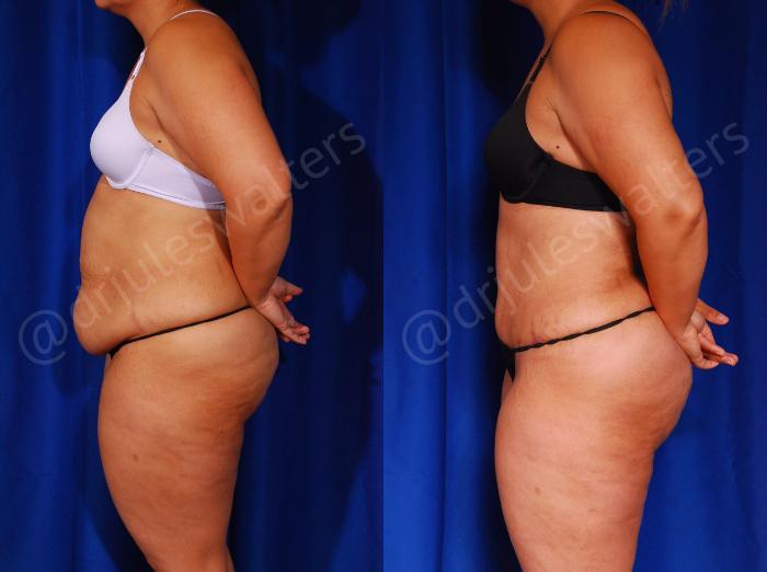 Before & After Tummy Tuck Case 57 View #3 View in Metairie and New Orleans, LA