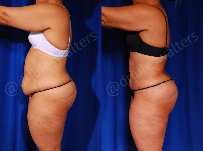 Before & After Tummy Tuck Case 57 View #4 View in Metairie and New Orleans, LA