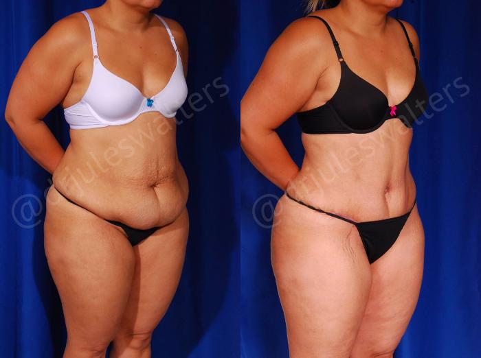 Before & After Tummy Tuck Case 57 View #5 View in Metairie and New Orleans, LA