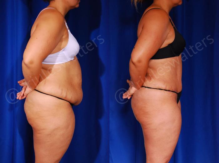 Before & After Tummy Tuck Case 57 View #6 View in Metairie and New Orleans, LA