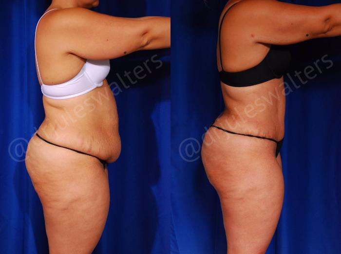 Before & After Tummy Tuck Case 57 View #7 View in Metairie and New Orleans, LA