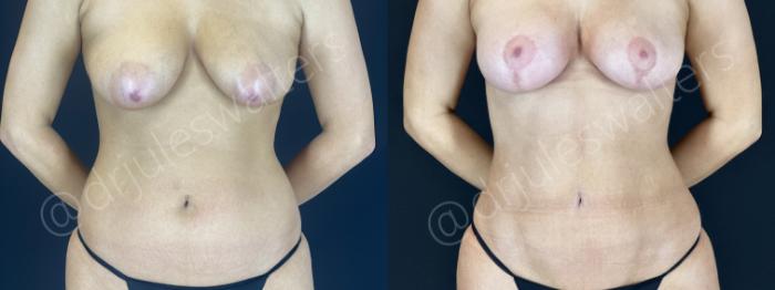 Before & After VASERlipo® Case 149 Front View in Metairie and New Orleans, LA