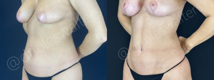 Before & After VASERlipo® Case 149 Left Oblique View in Metairie and New Orleans, LA