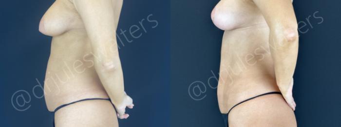 Before & After VASERlipo® Case 149 Left Side View in Metairie and New Orleans, LA