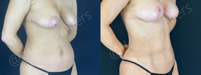 Before & After VASERlipo® Case 149 Right Oblique View in Metairie and New Orleans, LA