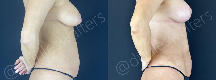 Before & After VASERlipo® Case 149 Right Side View in Metairie and New Orleans, LA