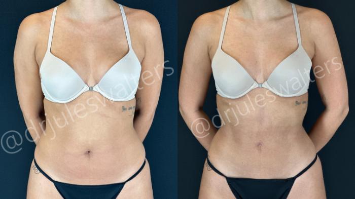 Before & After VASERlipo® Case 158 Front View in Metairie and New Orleans, LA