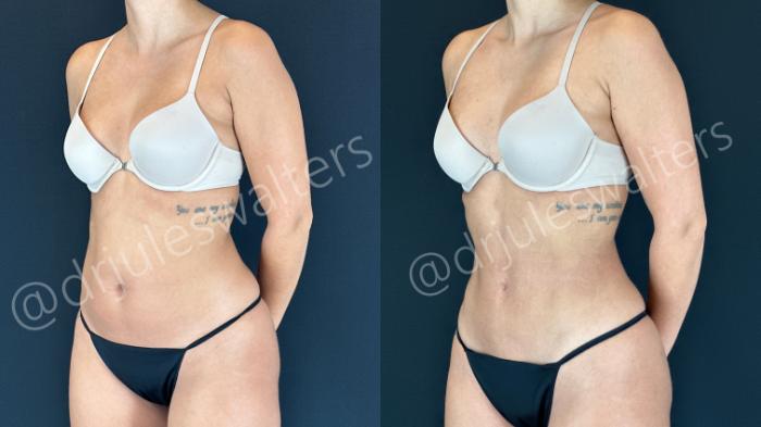 Before & After Hi-Definition Liposuction Case 158 Left Oblique View in Metairie and New Orleans, LA