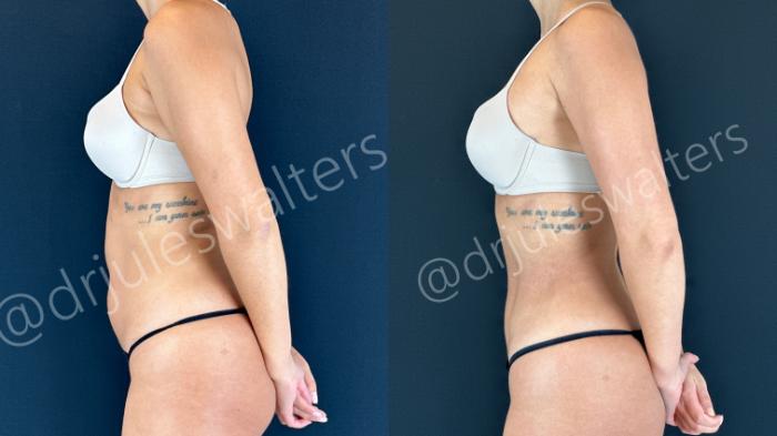 Before & After Hi-Definition Liposuction Case 158 Left Side View in Metairie and New Orleans, LA
