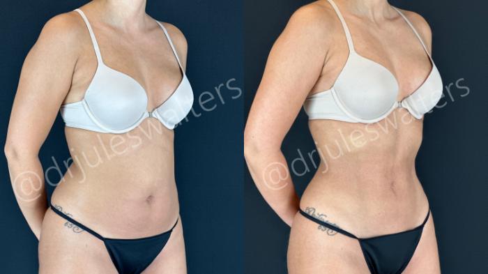 Before & After VASERlipo® Case 158 Right Oblique View in Metairie and New Orleans, LA