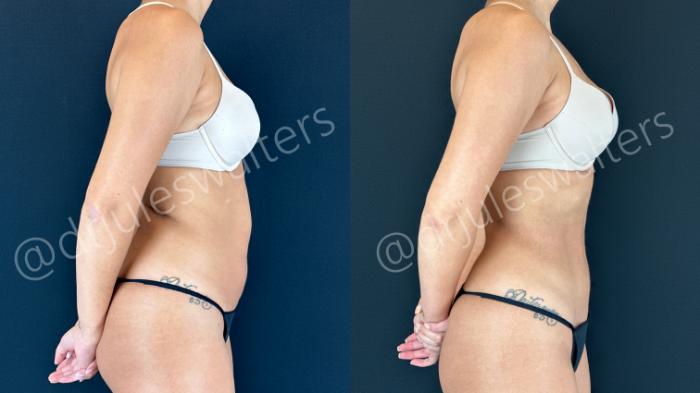 Before & After Hi-Definition Liposuction Case 158 Right Side View in Metairie and New Orleans, LA