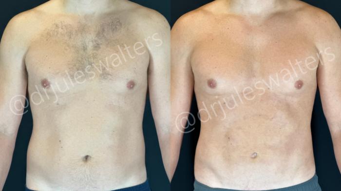 Before & After VASERlipo® Case 160 Front View in Metairie and New Orleans, LA