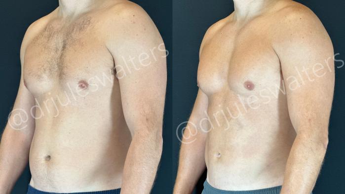 Before & After VASERlipo® Case 160 Left Oblique View in Metairie and New Orleans, LA