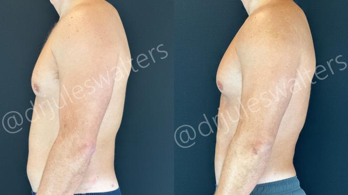 Before & After VASERlipo® Case 160 Left Side View in Metairie and New Orleans, LA