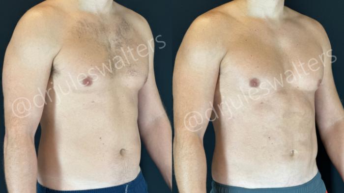 Before & After VASERlipo® Case 160 Right Oblique View in Metairie and New Orleans, LA