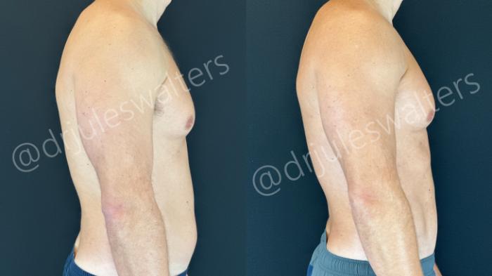 Before & After VASERlipo® Case 160 Right Side View in Metairie and New Orleans, LA