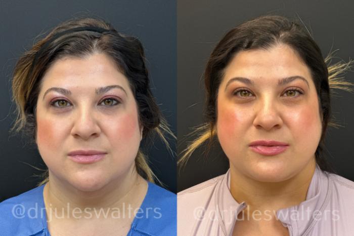 Before & After VASERlipo® Case 171 Front View in Metairie and New Orleans, LA