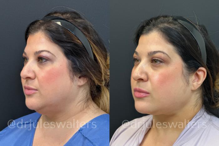 Before & After VASERlipo® Case 171 Left Oblique View in Metairie and New Orleans, LA