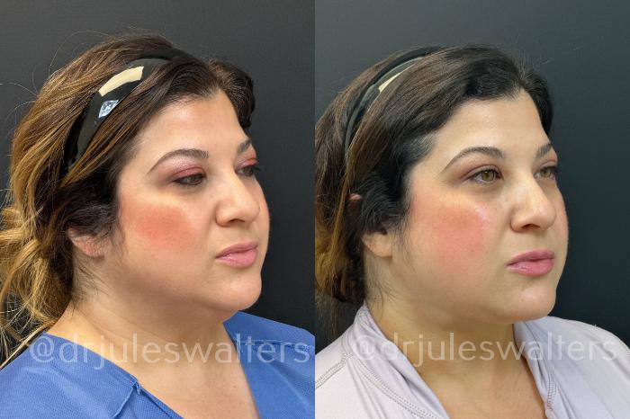 Before & After VASERlipo® Case 171 Right Oblique View in Metairie and New Orleans, LA