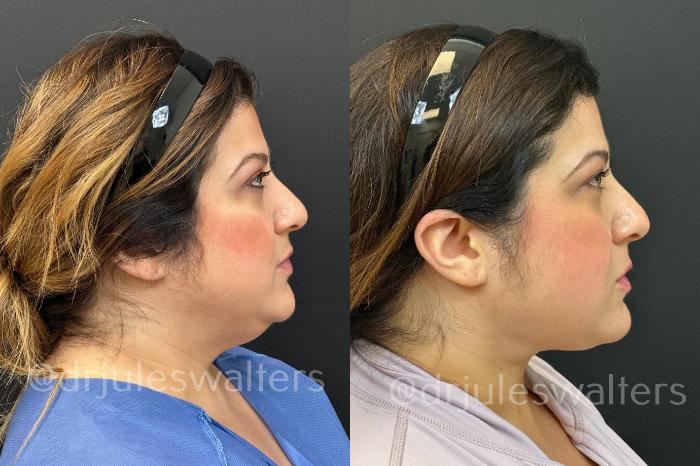 Before & After VASERlipo® Case 171 Right Side View in Metairie and New Orleans, LA