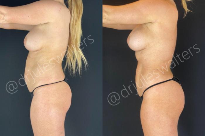 Before & After Liposuction Case 182 Left Side View in Metairie and New Orleans, LA