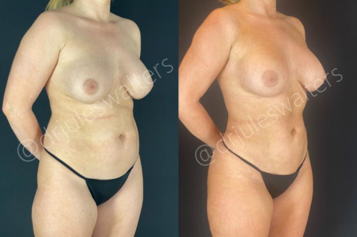 Before & After Liposuction Case 182 Right Oblique View in Metairie and New Orleans, LA