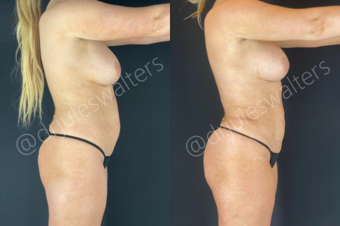 Before & After Liposuction Case 182 Right Side View in Metairie and New Orleans, LA