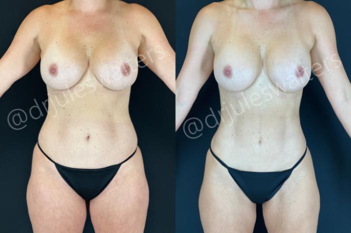 Before & After Liposuction Case 185 Front View in Metairie and New Orleans, LA