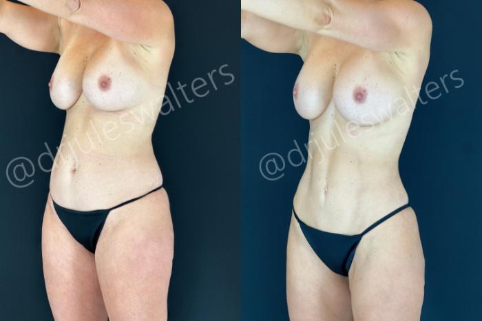 Before & After VASERlipo® Case 185 Left Oblique View in Metairie and New Orleans, LA