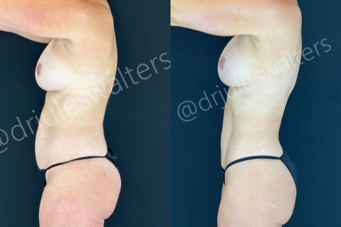 Before & After Tummy Tuck Case 185 Left Side View in Metairie and New Orleans, LA