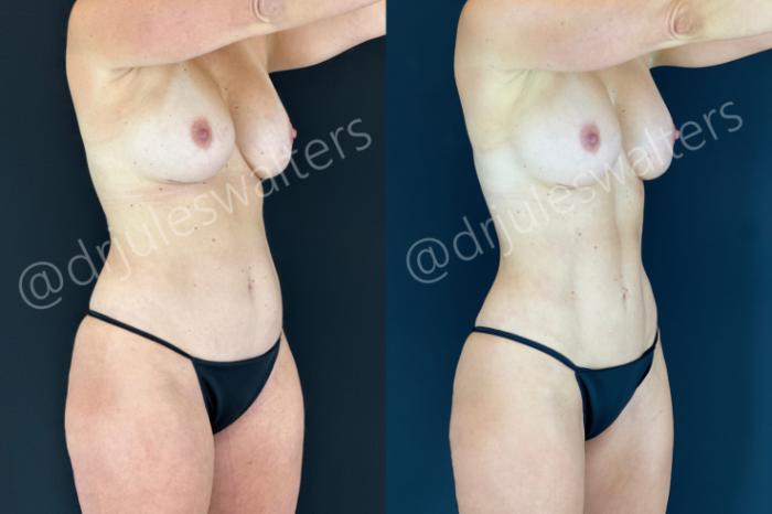 Before & After Tummy Tuck Case 185 Right Oblique View in Metairie and New Orleans, LA