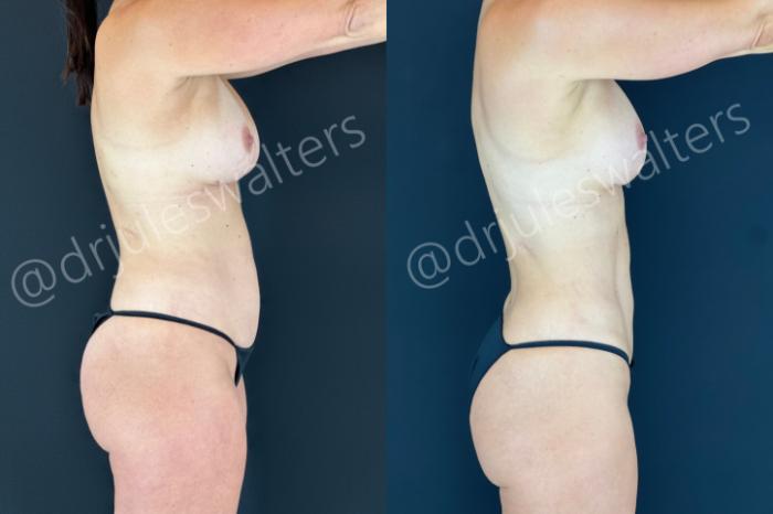 Before & After Tummy Tuck Case 185 Right Side View in Metairie and New Orleans, LA