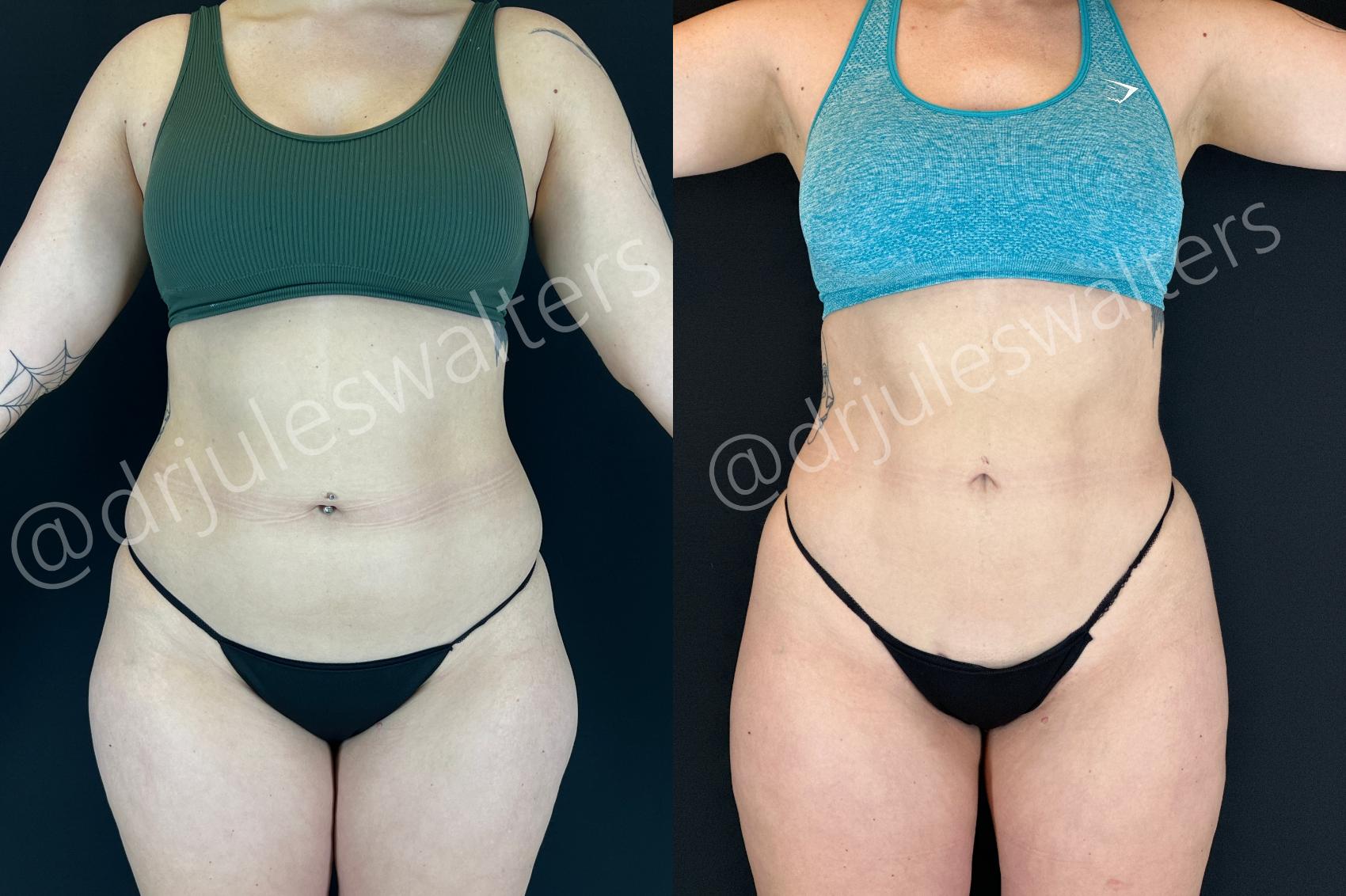 Before & After VASERlipo® Case 201 Front View in Metairie and New Orleans, LA