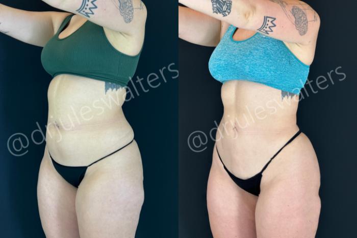 Before & After VASERlipo® Case 201 Left Oblique View in Metairie and New Orleans, LA