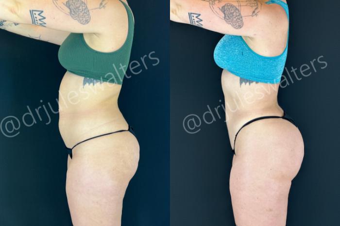 Before & After VASERlipo® Case 201 Left Side View in Metairie and New Orleans, LA