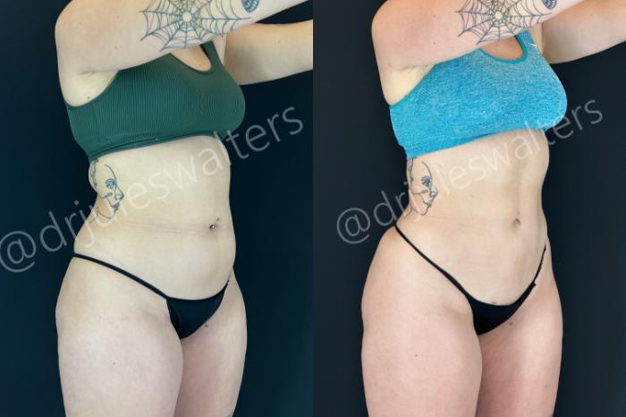 Before & After VASERlipo® Case 201 Right Oblique View in Metairie and New Orleans, LA